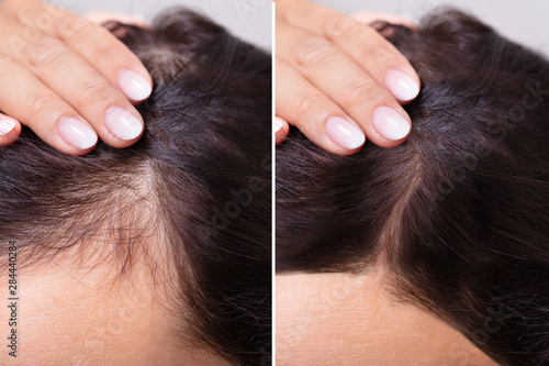 Fotomural Before And After Hair Loss Treatment