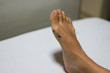 A doctor mark an Asian girl's feet Hallux Valgus before and after Proximal phalanx osteotomies.