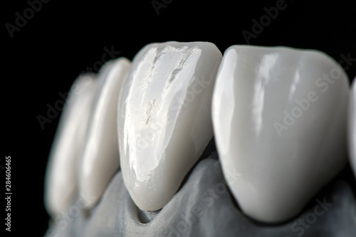 Fotomural White front teeth veneers on diagnostic model on dark background