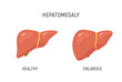 © kolonko - Enlarged liver hepatomegaly disease icon. Human liver health illustration anatomy design