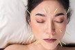 © geargodz - woman undergoing acupuncture treatment on face