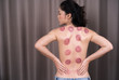 © geargodz - woman receiving cupping treatment on back