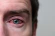 © ink drop - Close up of a severe bloodshot eye. Blepharitis, Conjunctivitis condition