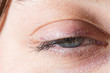 © Alessandro Grandini - Closeup of female eye with ptosis: drooping eyelid, amblyopia condition called lazy eye.