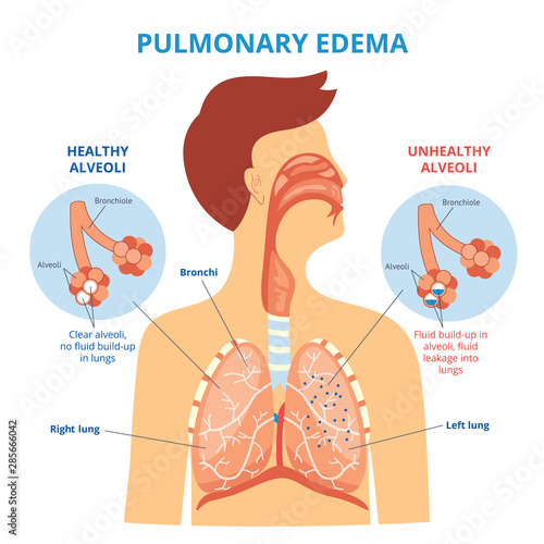 Pulmonary edema - respiratory lung disease infographic with flat cartoon man drawing showing his internal organs