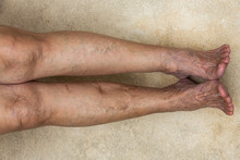 Varicose Veins On Legs With Feet In Senior Women