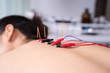 © geargodz - woman undergoing acupuncture treatment with electrical stimulator on back