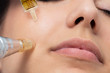 © karelnoppe - Macro detail of micro needle cosmetic treatment on female cheek.