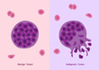 cancer and tumor cell stage and development vector /  malignant and benign type