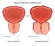 Cartoon Benign Prostatic Hyperplasia Infographics Concept Card Poster. Vector