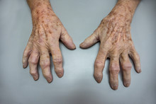 Mature Patient With A Osteoarthritis