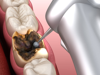 Caries removing process. Medically accurate tooth 3D illustration.