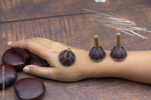 Cuadros en Lienzo Moxa rolls on on arm concept chinese teeatment