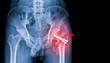 © Choo - X-ray image of hip fracture in elderly people cause by falling process in blue tone with copy space. Medical and health care concepts.