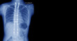 X-ray image of spine show Scoliosis deformity surgery fix by long metal rod and many screw for spinal bend in adult people. Adult scoliosis fix. Medical health care concepts.