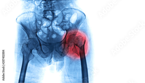 X-ray image of hip fracture in elderly people cause by falling process in blue tone with copy space. Medical and health care concepts.