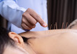 © geargodz - woman undergoing acupuncture treatment on back