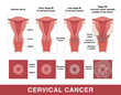 © Tsuyna - Cervical cancer. Three stages of cancer. Vector medical illustration with inscriptions. Female reproductive organs. Frontal view in a cut and top view.