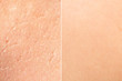 © Alessandro Grandini - A side by side comparison of human skin showing scarring and blemishes against blurred flawless youthful skin, before and after dermatologist treatment.