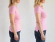 Side view of woman before and after breast lift enhancement and augmentation with implants surgery