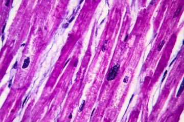 Poster - Histopathology of heart hypertrophy, high magnification. Photomicrograph showing hypertrophic myocardium with thick muscle fibers and enlarged and dark nuclei.