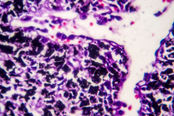 Sticker - Histopathology of smoker's lung. Light micrograph showing accumulation of carbon particles in lung tissue