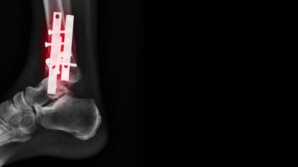 Wall Mural - x-ray footage fracture at tibia bone with internal fixation 