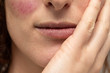 © Alessandro Grandini - A close up view on a caucasian woman resting her chin on hand, with visible cracked lips and rosacea, in need of moisturization and dermatologist.
