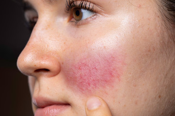 A young caucasian woman is seen closeup and from the side, pointing towards her red flushing cheek with blotches and dilated blood vessels, al symptomatic of rosacea