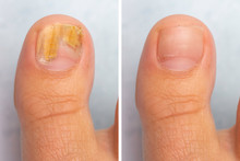 Before And After Topical Antifungal Treatment Is Seen In The Big Toe Of A Person Suffering From Onychomycosis, A Fungal Infection Causing Yellowing Of The Toenail.