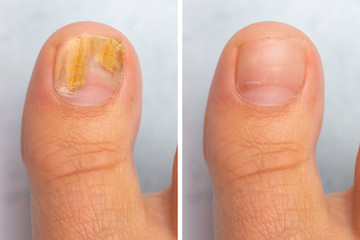 before and after topical antifungal treatment is seen in the big toe of a person suffering from onyc