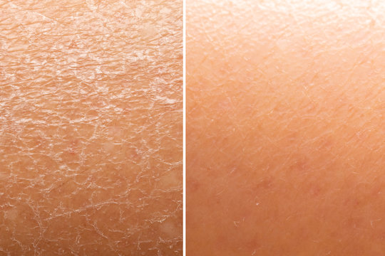 before and after skin moisturization is seen in detail, with dried and cracked skin against a flawle