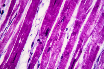 Sticker - Histopathology of heart hypertrophy, high magnification. Photomicrograph showing hypertrophic myocardium with thick muscle fibers and enlarged and dark nuclei.