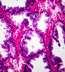 Poster - Benign prostatic hyperplasia, light micrograph, photo under microscope showing dilated glands and papillary projections inside the glands lumen