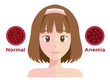anemia vector . low red blood cell icon / women