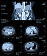 ct scan abdomen and body