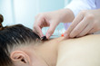 © kamonrat - Electro-Acupuncture.Traditional Chinese acupuncture and Electroacupuncture on body of patient