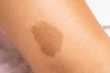 A closeup view of a large brown benign irregularity on the skin of a person, birthmark on the leg of a human patient.