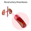 Renal artery thrombosis. Vector medical anatomy illustration.