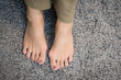 © myboys.me - Closeup of barefeet woman with painful toes -  Medical condition called bunions or hammer toes (Hallux valgus) painful and suffering. Middle aged woman's health concept - feet problem.