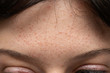 A closeup view on the forehead of a young caucasian girl suffering from oily skin, resulting in spots, scars and blemishes, a common complaint in young adults.