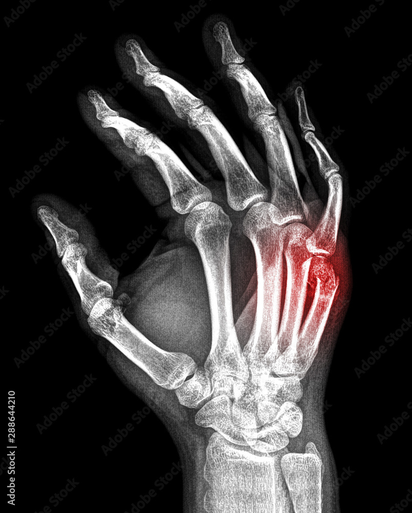 x-ray-of-the-metacarpal-fracture-stock-photo-adobe-stock