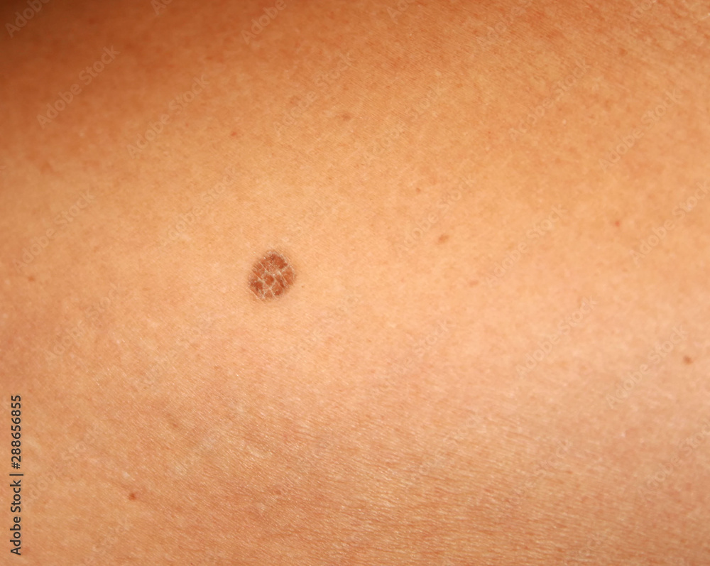 brown-spots-on-the-skin-spot-dark-stock-photo-adobe-stock