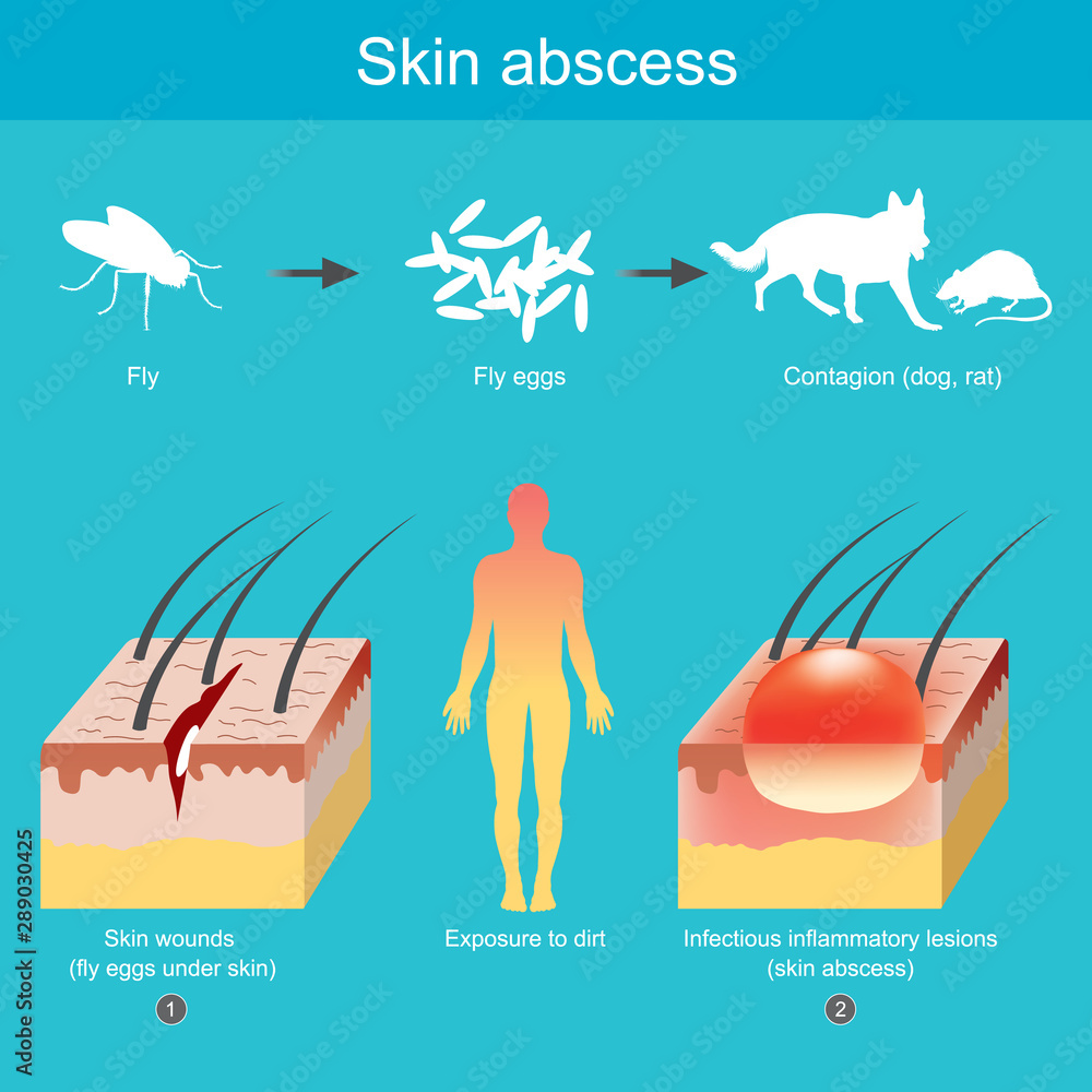 Skin abscess. Inflammation of the skin resulting from pathogens ...