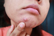 Woman squeezing pimple with dirty bare hands, Removing pustules whitehead acne from face, Problems with acne and scar on the female skin.