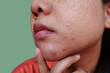 Pustules whitehead acne from face, Problems with acne and scar on the female skin, Skin problem
