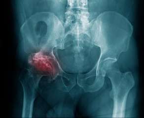 Canvas Print - x-ray image hip avascular necrosis in blue tone 