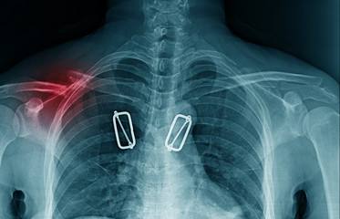 Wall Mural - shoulder pain x-ray footage with red hight light on shoulder joint, clavicle fracture with pain around shoulder joint