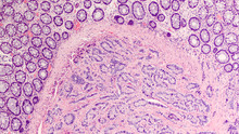 Photomicrograph Of A Carcinoid Tumor, A Type Of Neuroendocrine Tumor (NET), Which Presented As A Colon Polyp During Routine Colonoscopy.  Spread To Liver Can Cause Symptoms Of Carcinoid Syndrome.