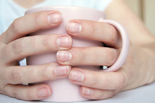 Many White Spots On Fingernails ( Leukonychia ) Due To Calcium Deficit Or Stress. Female Hands Holding Mug